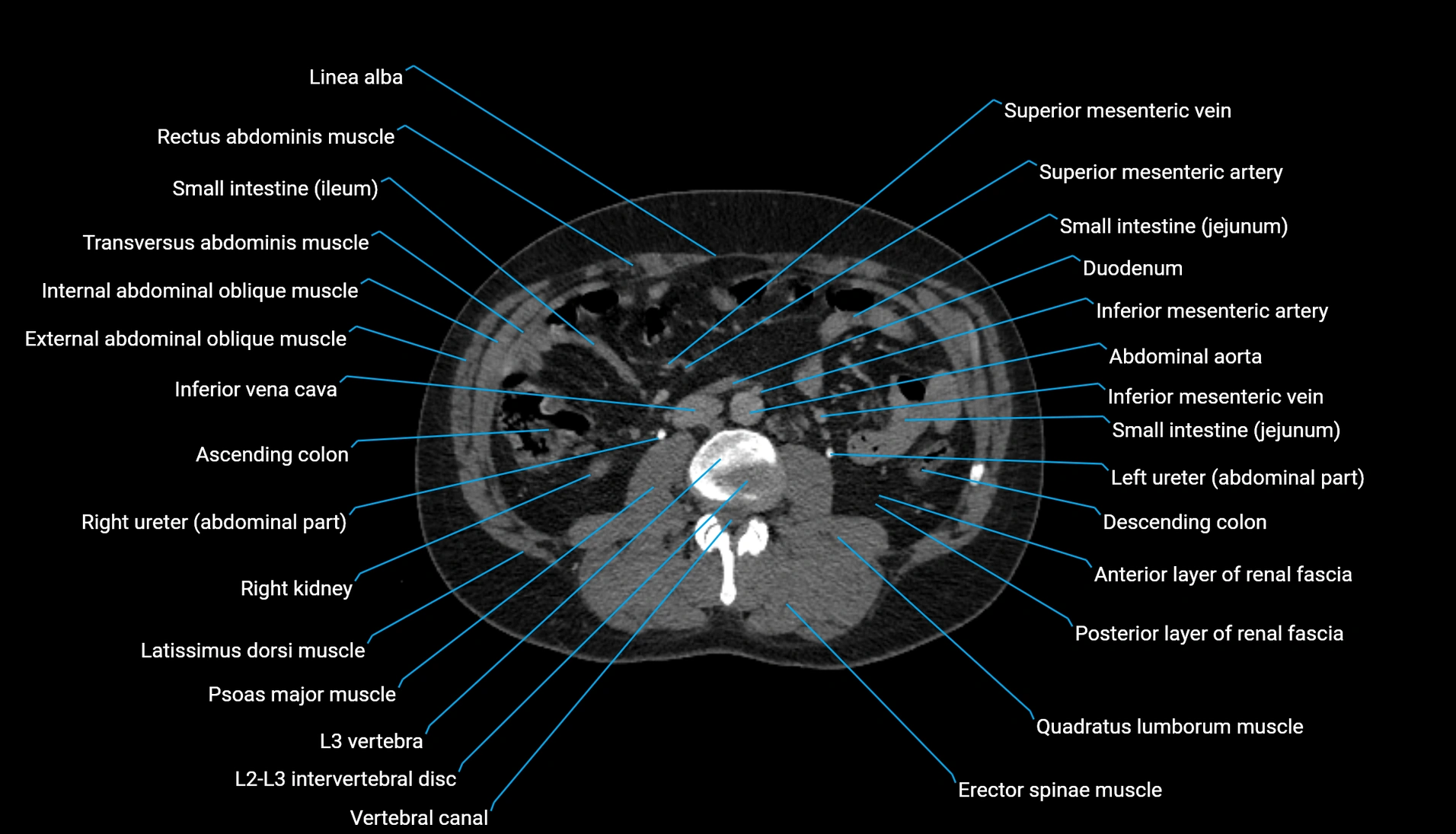 CT urogram axial cross sectional anatomy  labelled radiology image-00126.webp